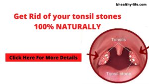 How to get rid of tonsil stones forever