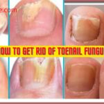 How to get rid of toenail fungus | Toenail Fungus Causes and Treatment