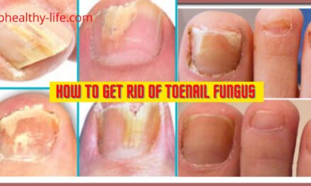 How to get rid of toenail fungus | Toenail Fungus Causes and Treatment