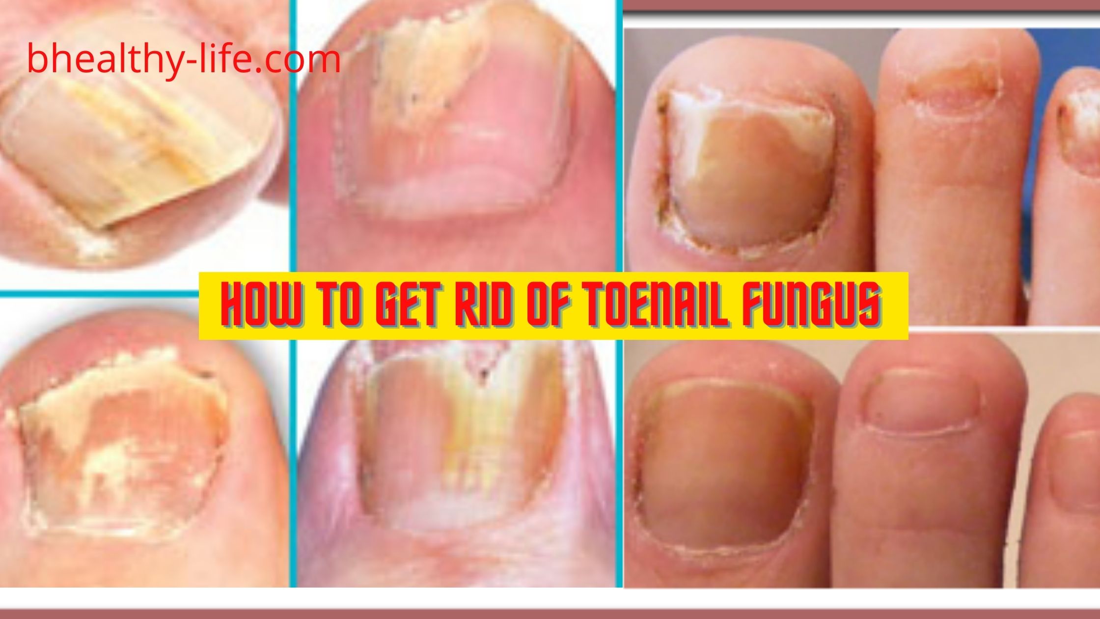 how-to-get-rid-of-toenail-fungus-toenail-fungus-causes-and-treatment