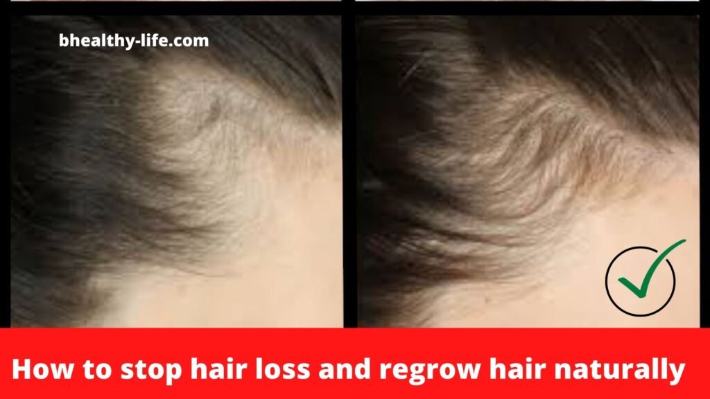 How to stop hair loss and regrow hair naturally - Bhealthy Life